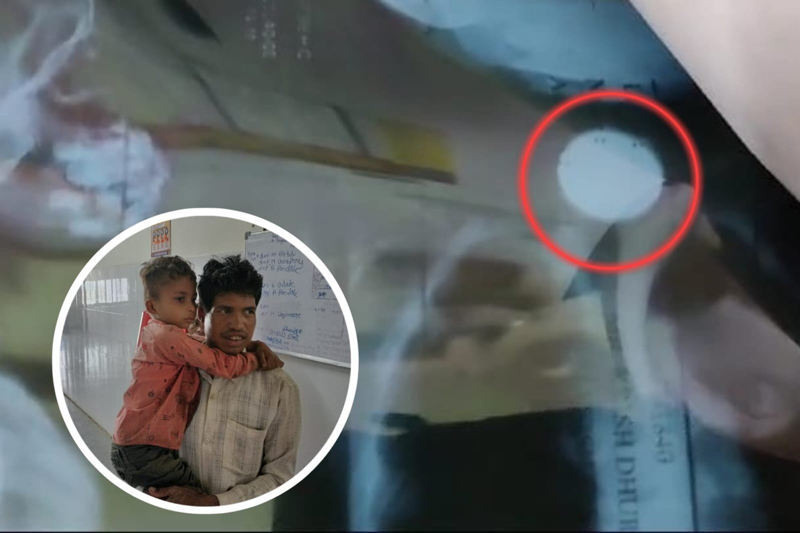 Betul News | Innocent child swallowed 2 rupee coin