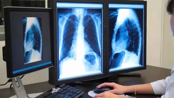 टीबी से होने वाली मौतों को कम कर