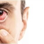 गुलाबी आंख (कंजंक्टिवाइटिस)