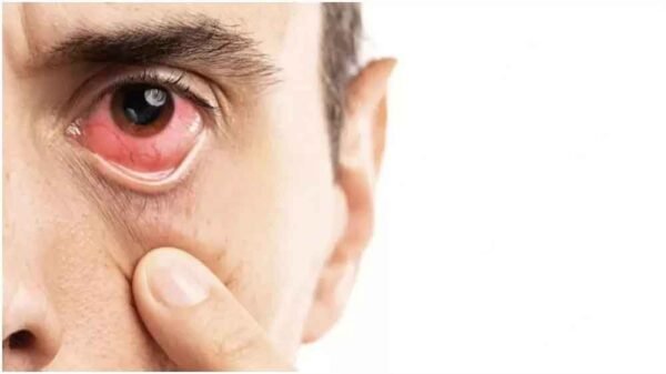 गुलाबी आंख (कंजंक्टिवाइटिस)