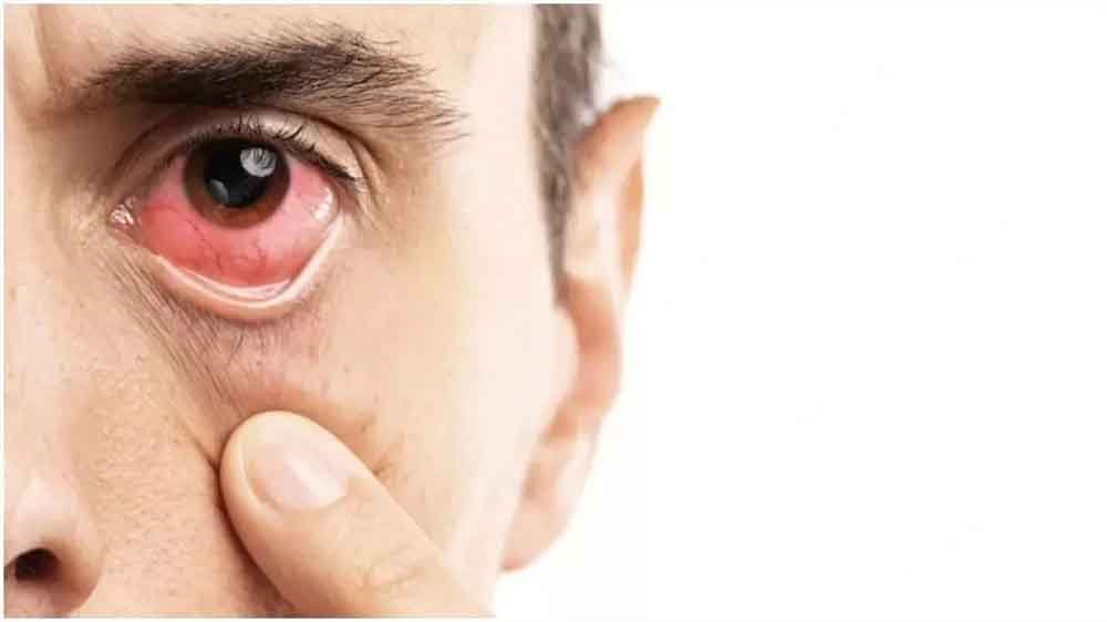 गुलाबी आंख (कंजंक्टिवाइटिस)