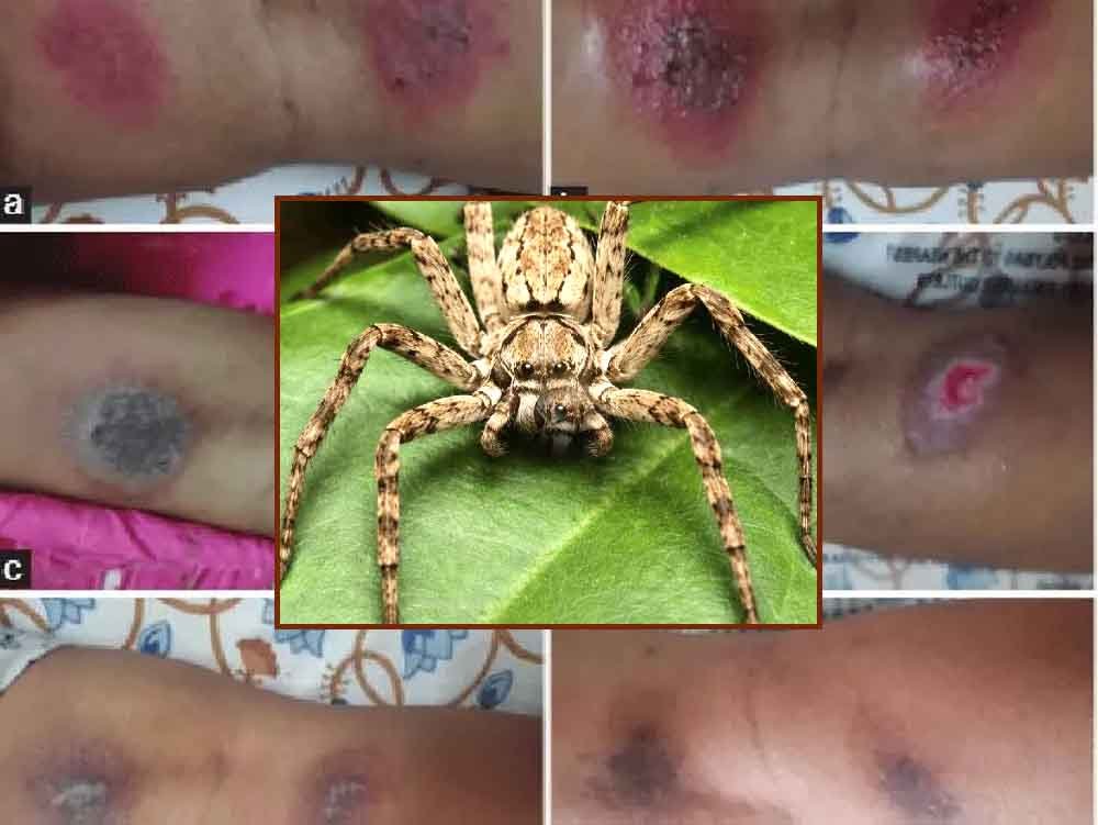 ‘हार्मलेस’ मानी जाने वाली मकड़ी भी