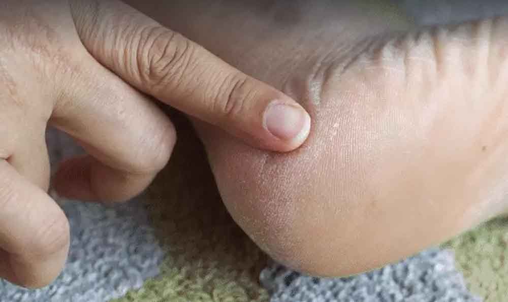 सर्दियों में फटी एड़ियां: कारण, लक्षण